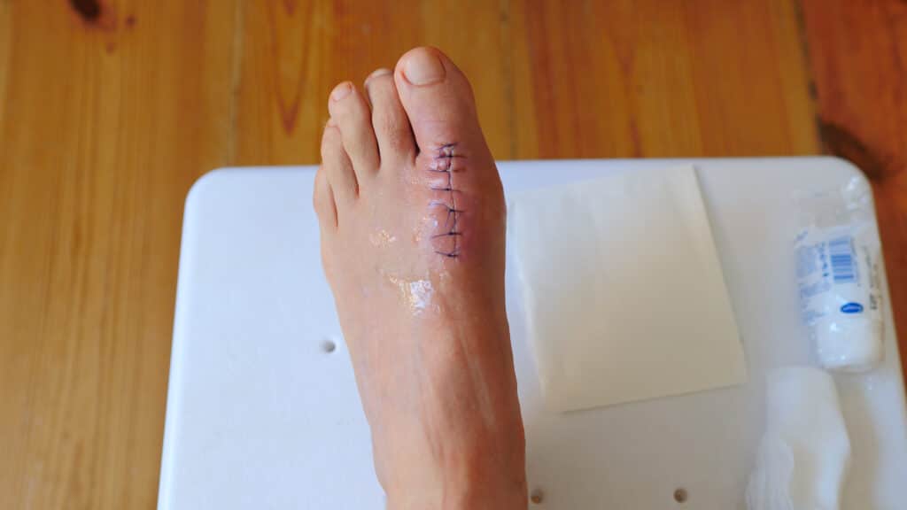 Postoperative sutures on the big toe after surgery for hallux rigidus.