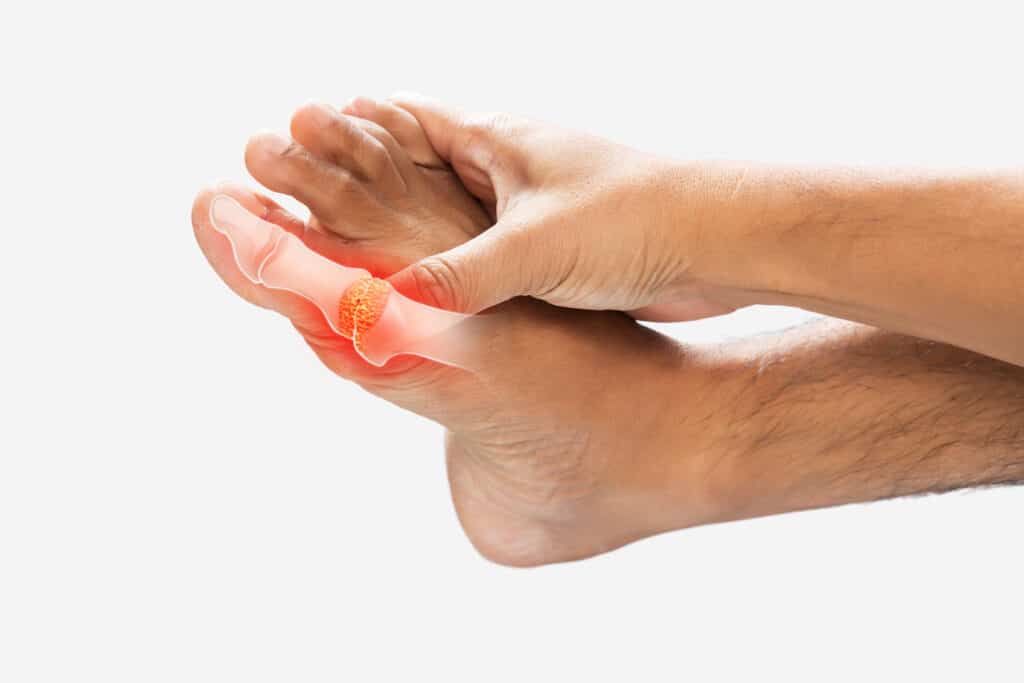 The joint at the base of the big toe, the metatarsophalangeal (MTP) joint, red and sore from hallux rigidus.