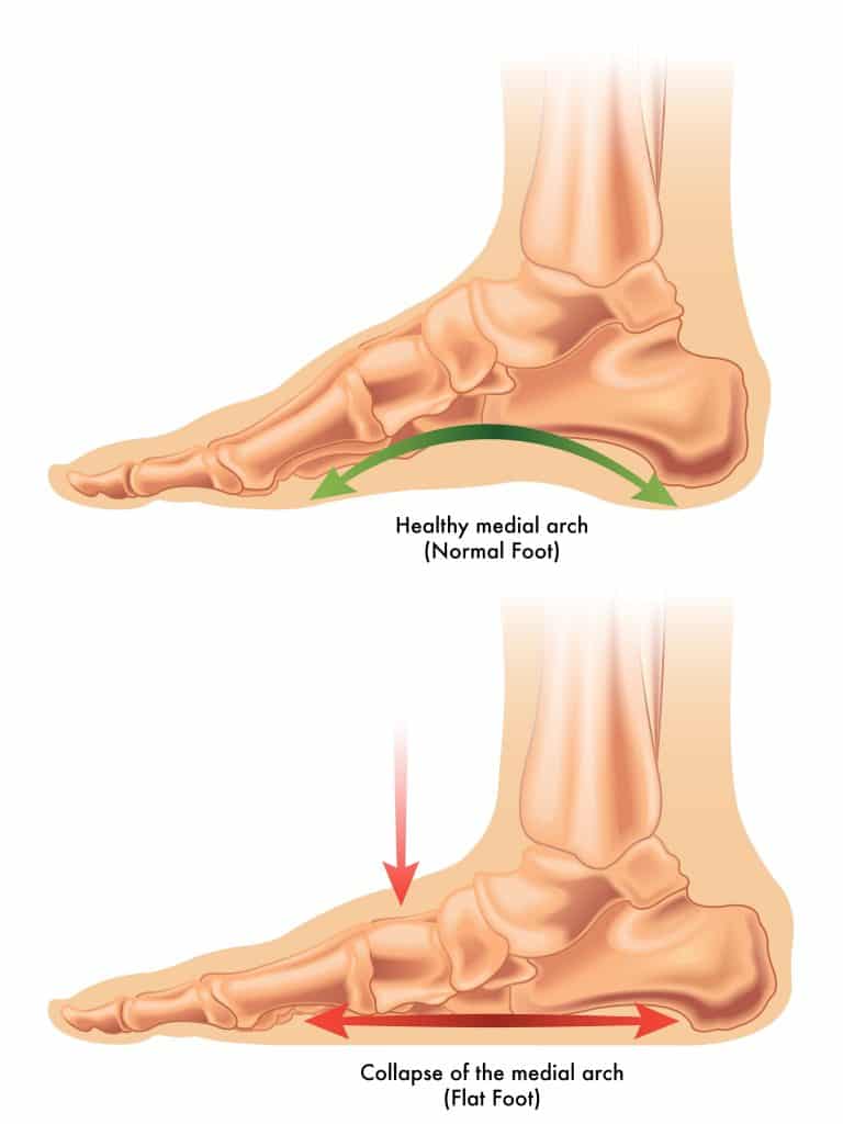 An illustration of high arches next to a flat foot, which can cause overpronation.