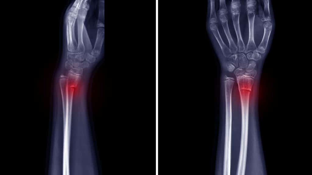 Ann X-ray showing a broken radius, classified as a broken wrist.