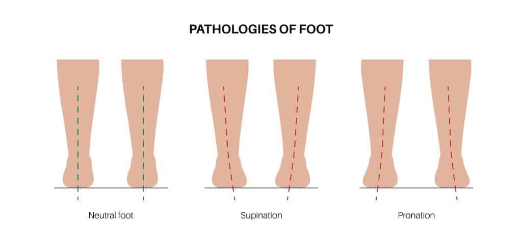 An illustration of pronation vs supination as well as a neutral foot.