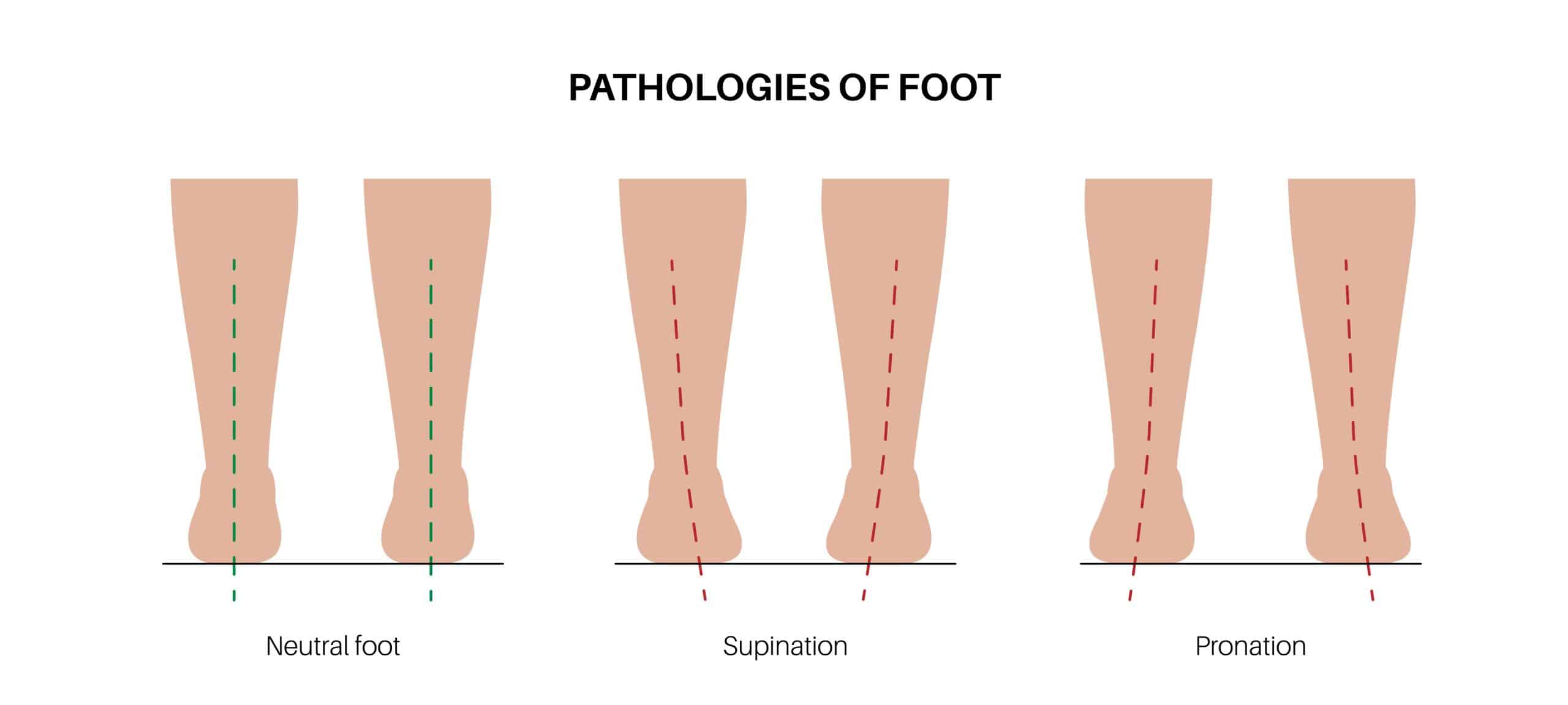 Pronation vs Supination for Healthy Ankles, Feet, and Hands