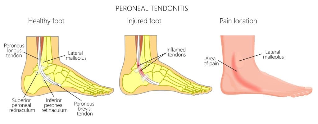 Illustration of peroneal tendons in a healthy foot, inflamed tendons in an injured foot, and foot pain in the lateral malleolus tendon.