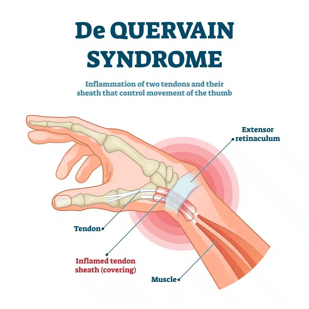 A medical illustration showing thumb pain and inflammation due to DeQuervain tenosynovitis.