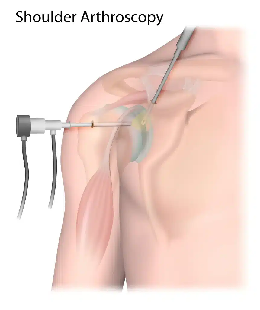 An illustration of arthroscopic shoulder surgery.