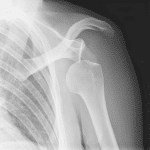 xrays are often necessary for common shoulder injuries