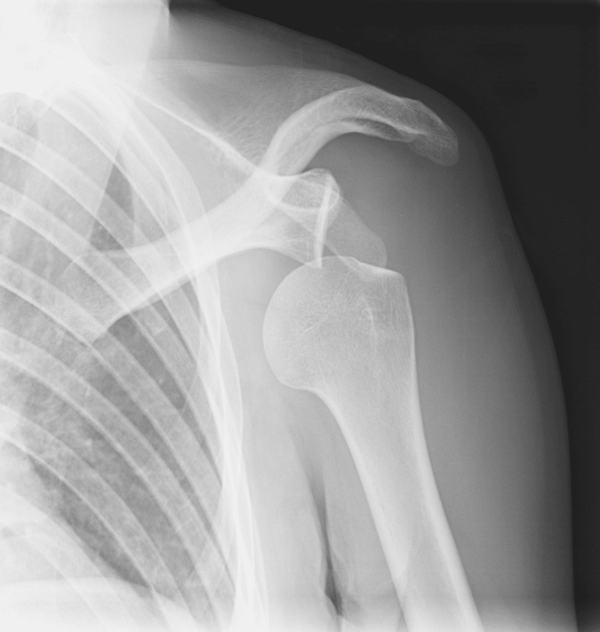 common shoulder injuries require xrays