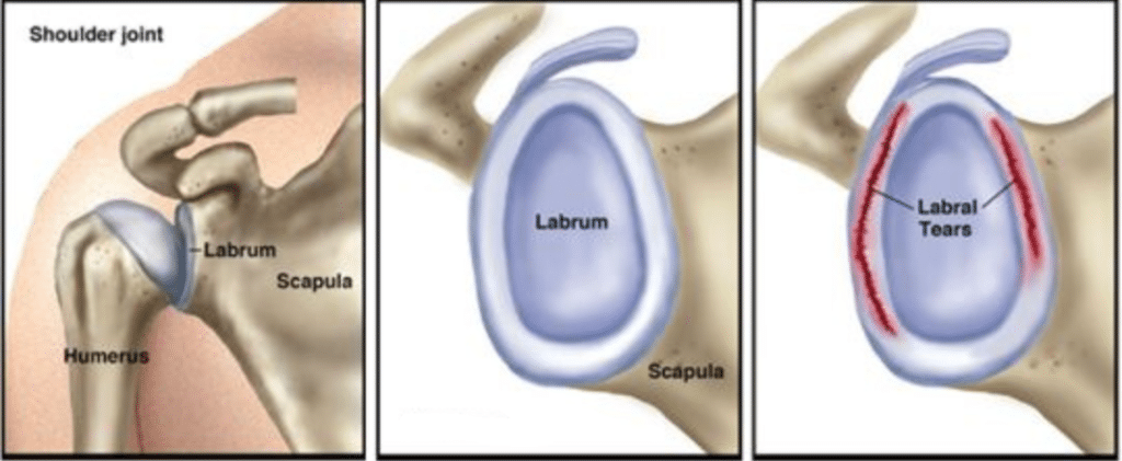 labram tears are a common shoulder injury