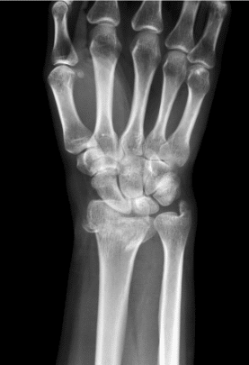 distal radius fracture